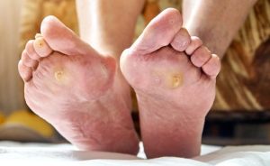 Callouses on the bottom of the foot which are caused in this case by a hammer toe.