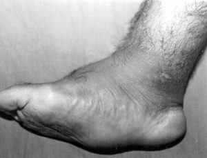 A Diabetic Charcot Foot which has a rocker bottom