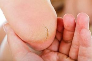 A heel with a crack in it.