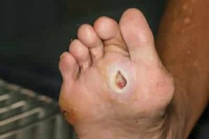 A Diabetic Wound on the bottom of the foot.