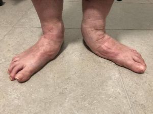 A pair of extremely flat feet.