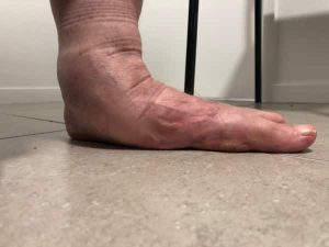 A very flat foot.