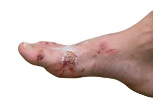A foot with recent cuts and scratches