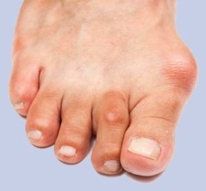 A foot with both hammer toes and bunions