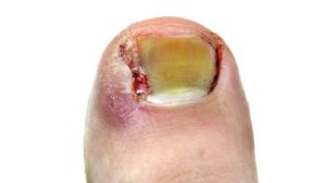 An acutely infected ingrown toenail