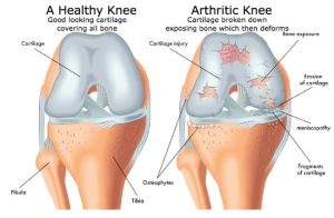 running and arthritic knees