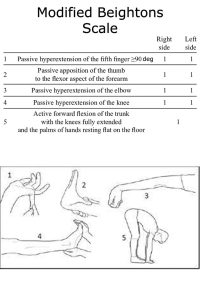The Modified Beighton's Scale is used to diagnose BJHS
