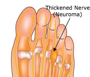 A Neuroma