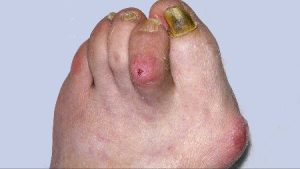 Overlapping toes with a wound on the top of the second toe