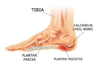 A Diagram showing where the plantar fascia is and where plantar fasciitis occurs
