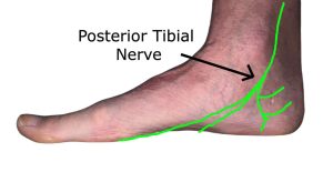 The posterior tibial nerve which gets compressed causing Tarsal Tunnel Syndrome
