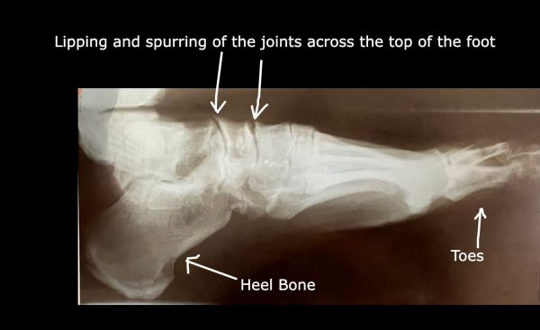 Arthritis on the top of the foot on XRay