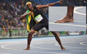 Usain Bolt's pronated foot up close