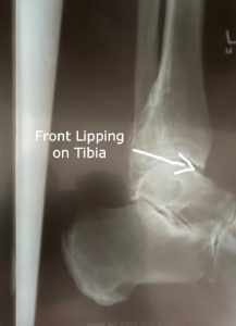 X-ray of an ankle with lipping and spurring preventing normal motion
