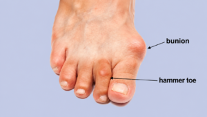 A foot with a bunion and hammer toe