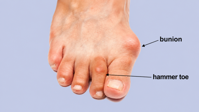 A foot with a bunion and hammer toe