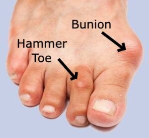 Hammer Toe and Associated Bunion