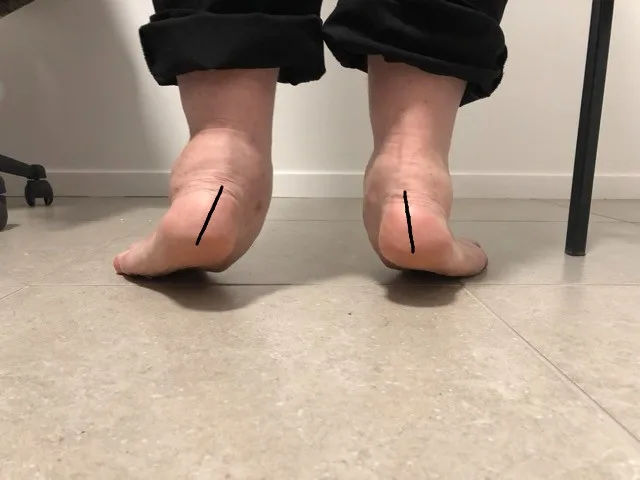 Everted heels in Acquired Flat Foot