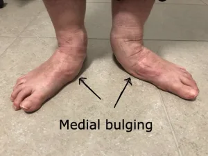 A medial bulge when standing in acquired flat foot
