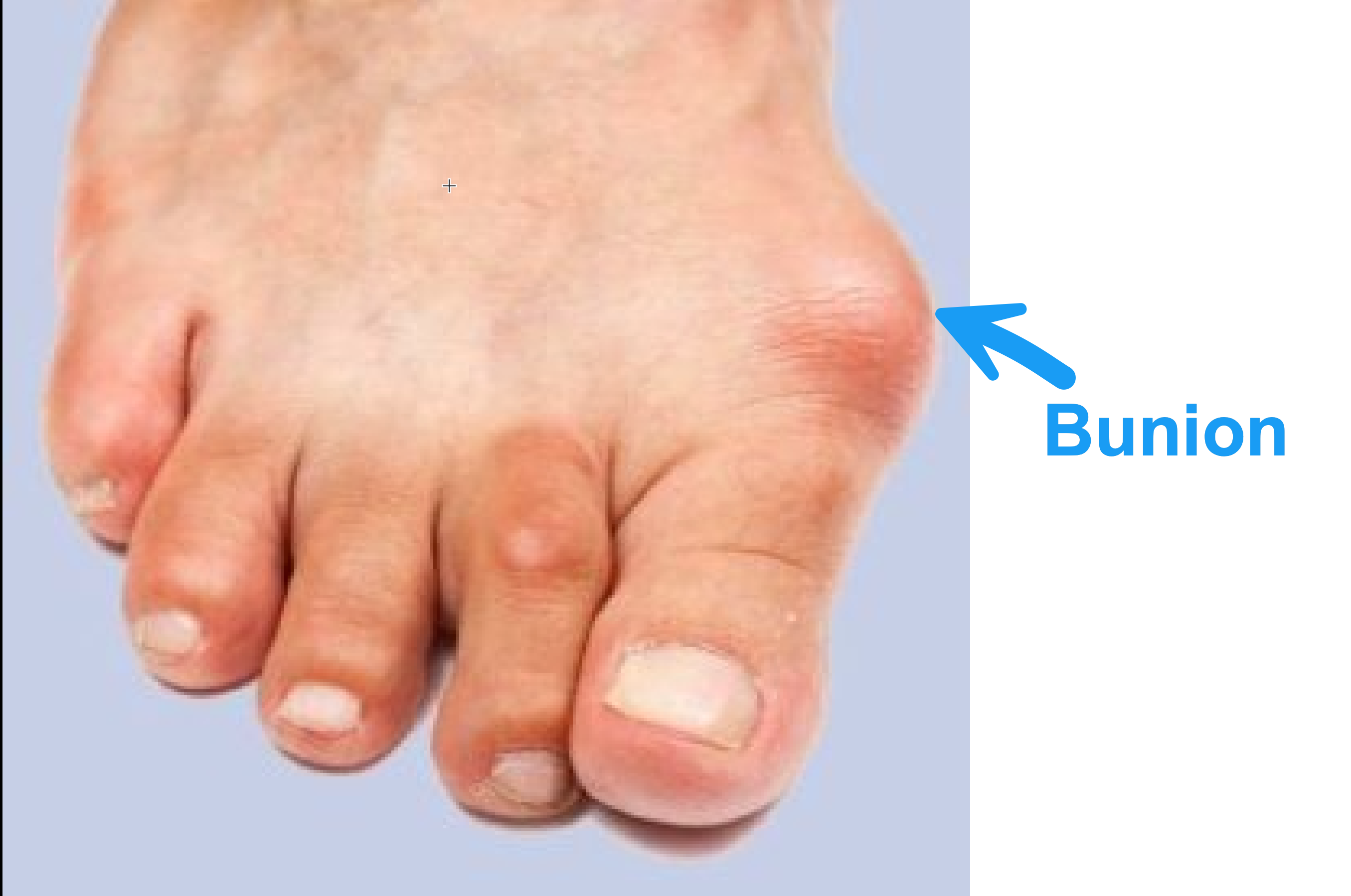 A picture of a bunion